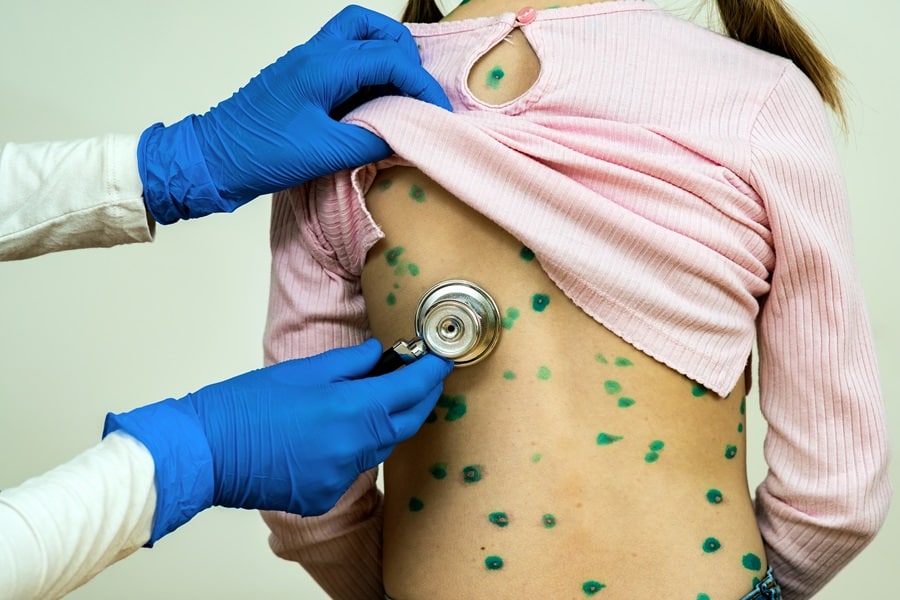 Measles Outbreak In Florida
